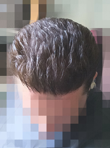 Dr Fares Seffen (Tunis, Tunisia) 2766 FUE results (Midscalps + Vertex) Day 0 --> 07 Months later photo