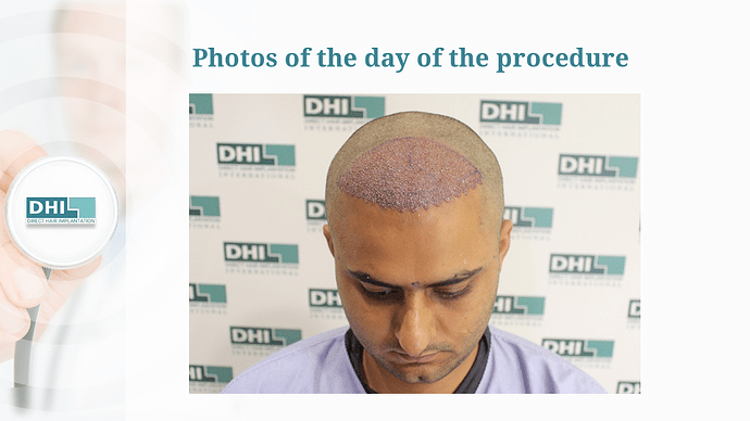 DHI India Result – 1784 Grafts photo