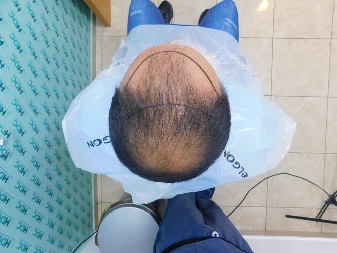 Two FUE Surgeries Totaling 6560 Grafts – HDC Hair Clinic photo