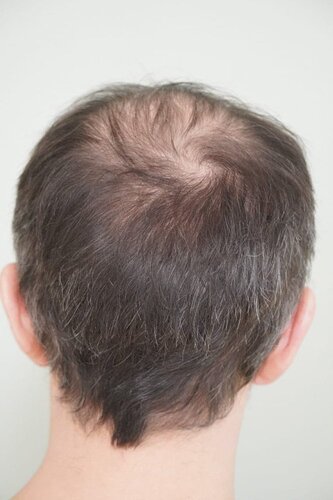 Hattingen Hair Clinic, 4 435: 4 093 FUT and 342 FUE. photo