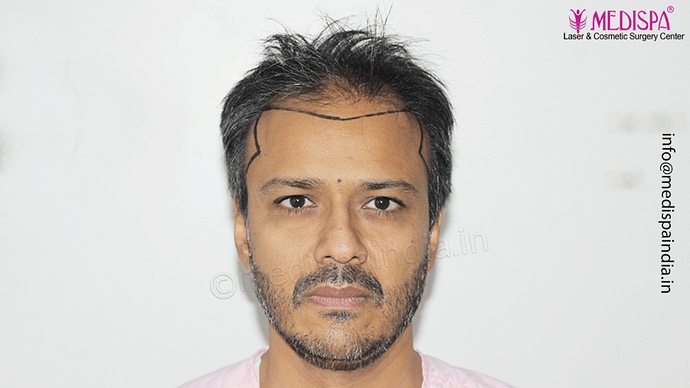Dr. Suneet Soni - 4889 Grafts | 2.5 Years Result | Combination FUT + FUE + Beard photo