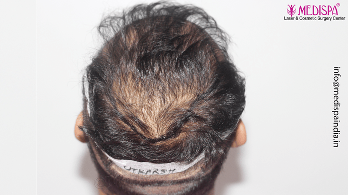 Dr. Suneet Soni - 4665 Grafts, Combine FUT + FUE + BHT (Beard) Technique photo