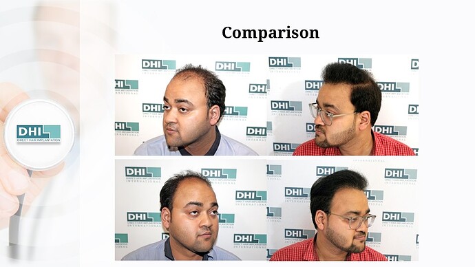 DHI India | NW Scale 5 | 2,923 Grafts | 9-Months DHI Hair Transplant Results photo