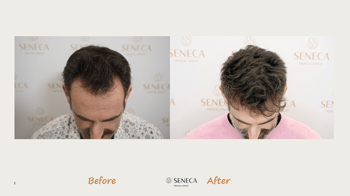 Seneca Medical Group - 1500 grafts with Direct Fue photo