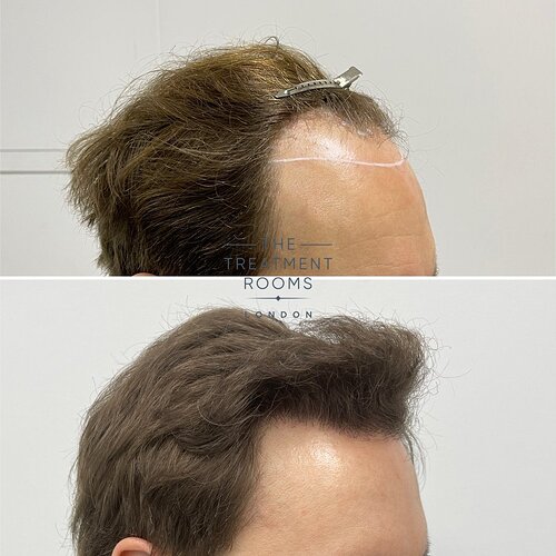 2037 Grafts Hairline and Crown Result- The Treatment Rooms London photo