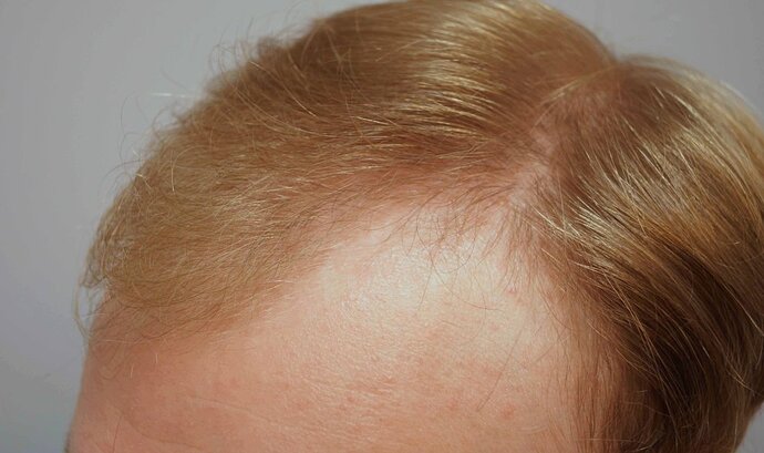 Dr B Farjo 1820 FUE (Fontal) Very early growth. photo