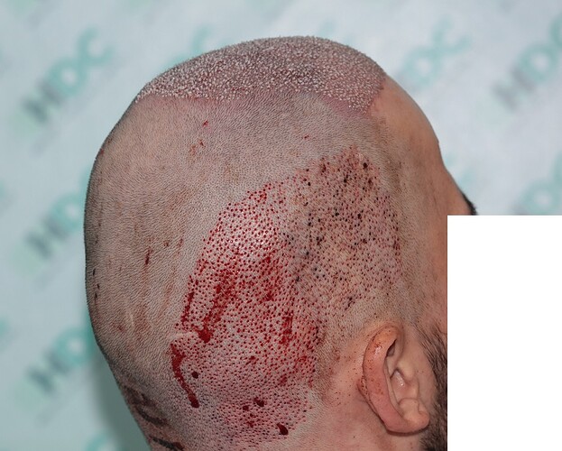 FUE Result for 4400 Grafts – 6 Months after – HDC Hair Clinic photo