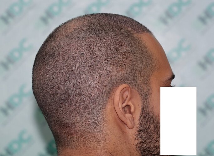 Result of 4000 grafts – 11 months after – NW class 4 photo