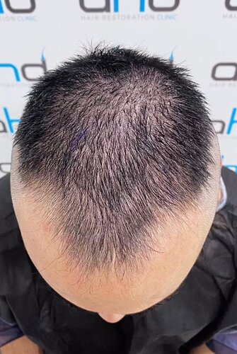 DR HAKAN DOGANAY/ 2000 GRAFTS / Implanter Pen+FUE photo