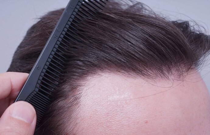 Dr Bessam Farjo FUE 1720 grafts to frontal recessions photo