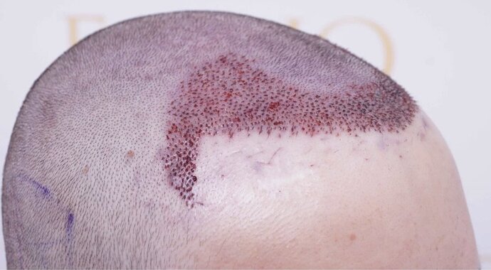 Dr Bessam Farjo FUE 1720 grafts to frontal recessions photo