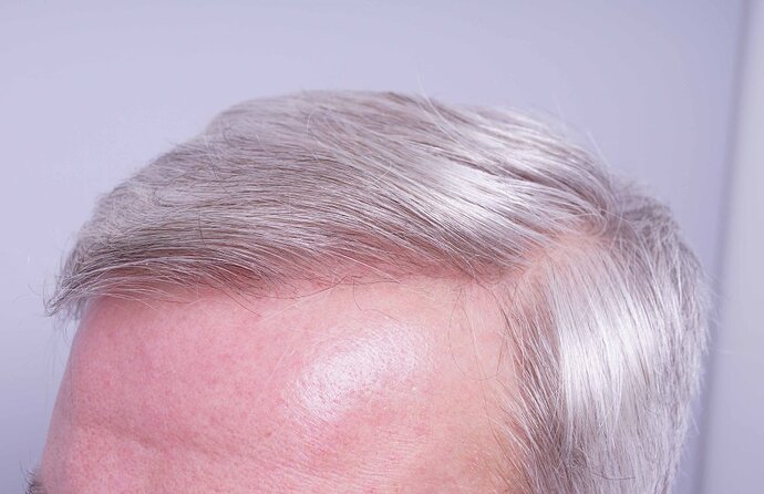 Dr B Farjo 1750g FUE to frontal recessions. photo