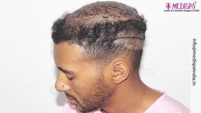 Dr. Suneet Soni - Afro Hair Transplant, 2 Sessions, 8355 Grafts, Combined FUT + FUE Technique, NW-VI, 5 Years Result photo