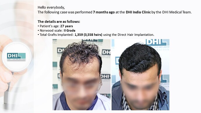 DHI India | NW 2 | 1,359 Grafts | 7-Months DHI Hair Transplant Results photo