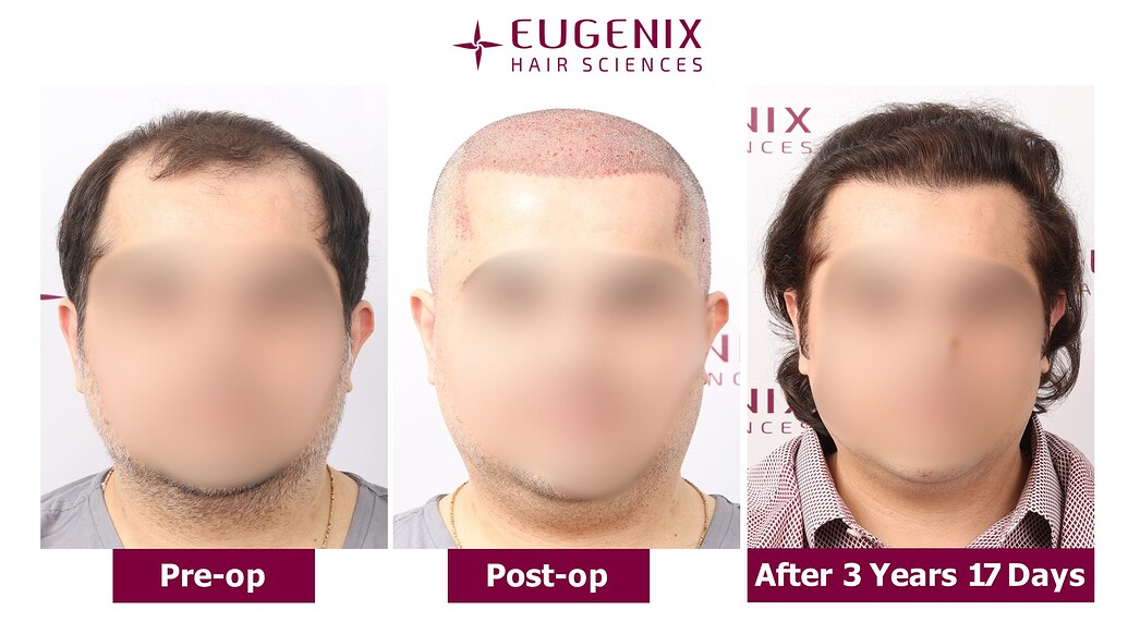 https://cdn.forumhairtransplant.com/optimized/3X/f/c/fc534330b3a02ae7e620ff8f0650367ffe8468cb_2_1035x582.jpeg