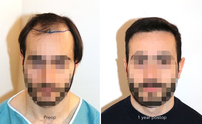 Case performed by Dr. Feriduni – 3744 FU in 1 procedure photo