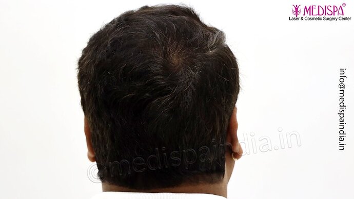 Dr. Suneet Soni - 4500 Grafts, 3 Year Result, NW-IV, Combine FUT + FUE Technique photo