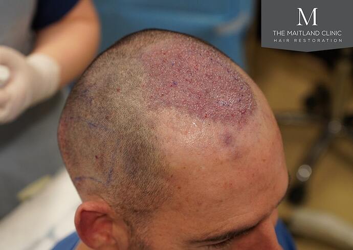 Dr Ball - The Maitland Clinic 1432 Grafts By FUE photo