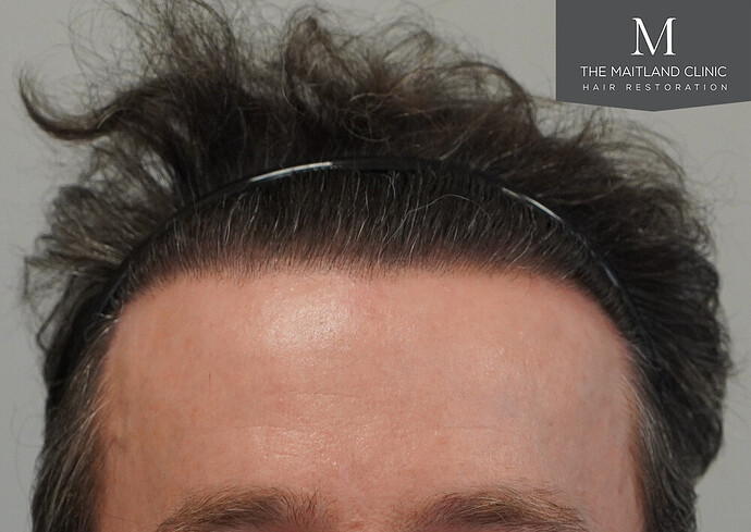 Before and after results: 1694 grafts by FUE at The Maitland Clinic (Dr Edward Maitland Ball) photo