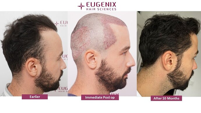 Dr. Somesh| Eugenix Hair Sciences Clinic | NW 3 | 3007 Grafts | 10 Months Post-op photo