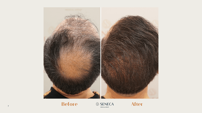 Seneca Medical Group - 4035 grafts with Direct FUE photo