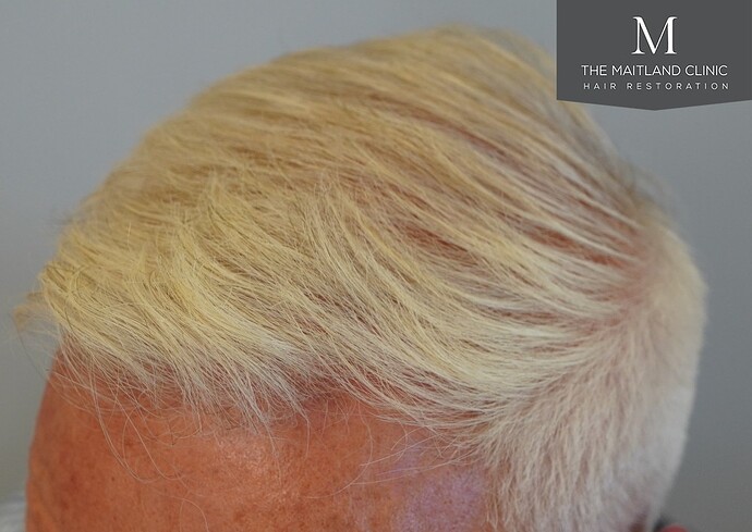 Dr Ball - The Maitland Clinic 2280 Grafts by FUE photo