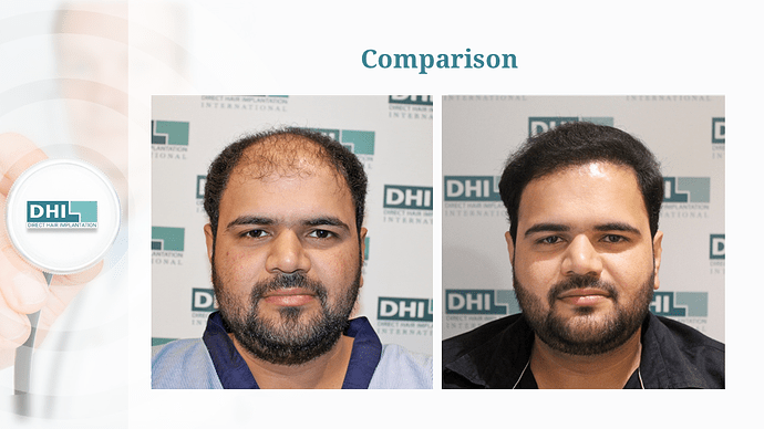 Full Scalp Coverage – 3511 Grafts | DHI India Result photo