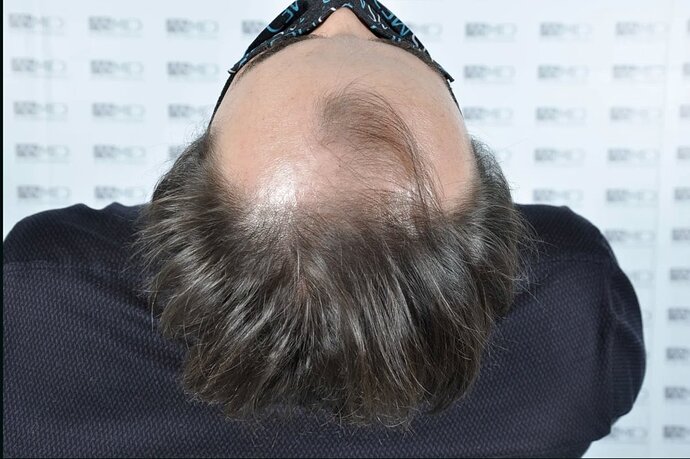 ASMED CLINIC - DR.KORAY - 5060 GRAFTS FUE photo