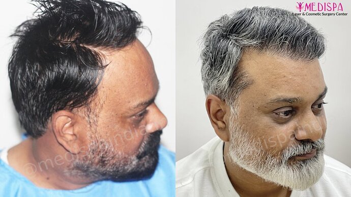 Dr. Suneet Soni - 4190 Grafts, Combine FUT + FUE + Beard Technique, NW- III photo