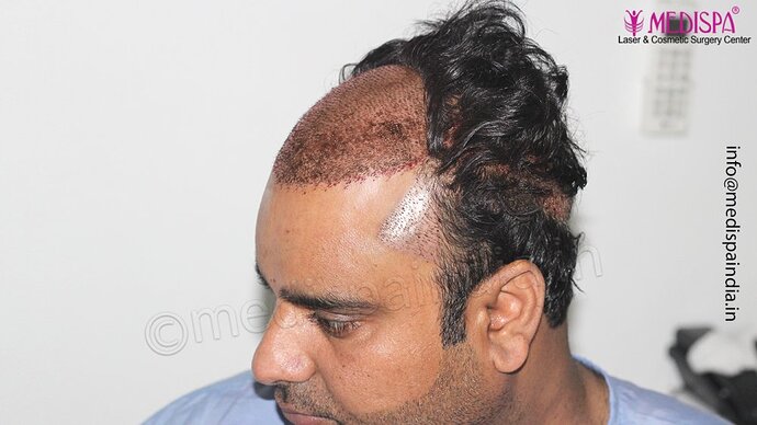 Dr. Suneet Soni - 4500 Grafts, 3 Year Result, NW-IV, Combine FUT + FUE Technique photo