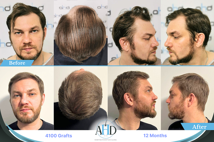 AHD Clinic Turkey - Hair Transplant Before & After Pictures - 4100 grafts - DHI photo