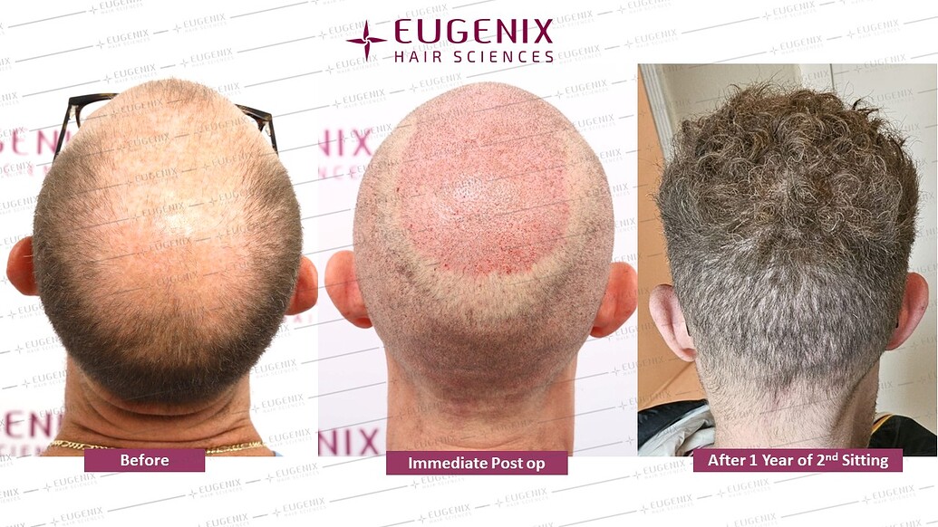 https://cdn.forumhairtransplant.com/optimized/3X/f/e/fe8232c1ea4c548f3032f3738bacf1ccb195db00_2_1035x582.jpeg