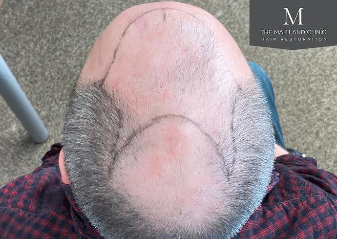 Dr Ball - The Maitland Clinic - 3 Months Propecia (Oral Finasteride) and Topical Minoxidil photo