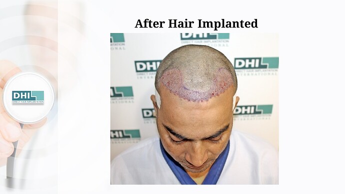 DHI India | NW Scale 3 | 1,445 Grafts | 1-Year DHI Hair Transplant Results photo