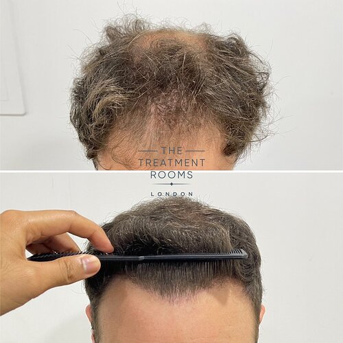 Crown and Hairline 1736 Grafts FUE Hair Transplant Result photo