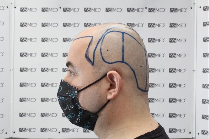 ASMED CLINIC - DR.KORAY - 5060 GRAFTS FUE photo