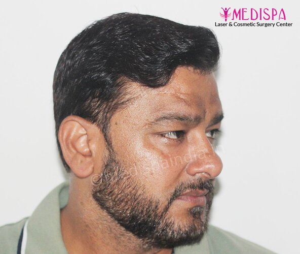Dr. Suneet Soni - 5000 Grafts, Combine FUT + FUE + BHT (Beard) Technique, NW-V, 2.5 Year Result photo