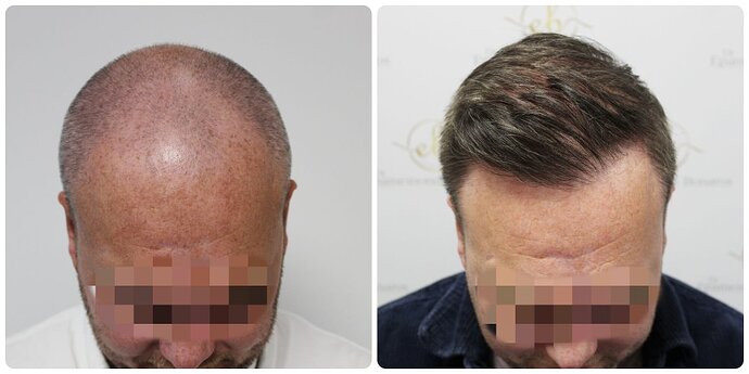 Dr Bonaros, Glasgow, UK / 4076 FUE grafts / 0-12 Months photo