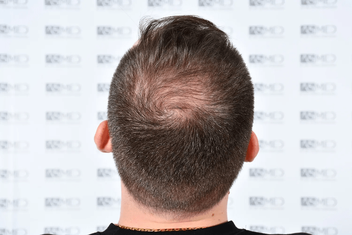 ASMED, Istanbul: 5,071 Manual FUE Grafts 0/12 Months photo