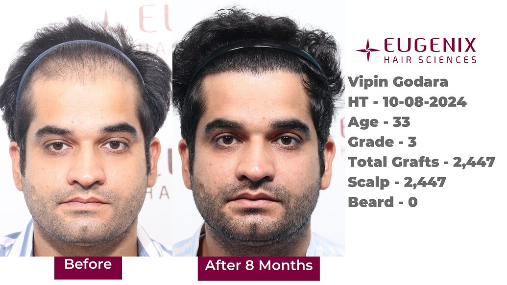 https://cdn.forumhairtransplant.com/optimized/3X/f/f/ff88ecb9f7f6cfea5fe169338d8a909307371381_2_1035x582.jpeg
