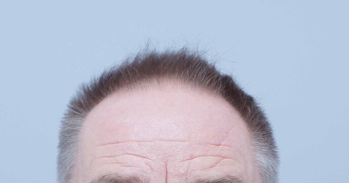 Dr B Farjo 2120g FUE to front and top photo