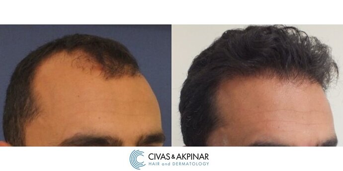 Civas&Akpınar Hair Transplant- FUE Hair Transplant Before & After Pictures (3100 Grafts) photo