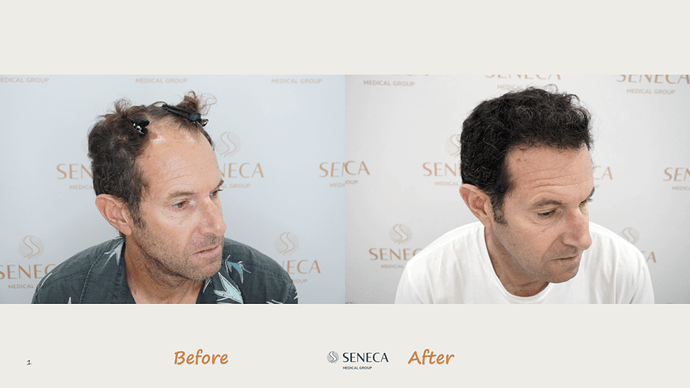 Seneca Medical Group - 1700 grafts with Direct Fue photo