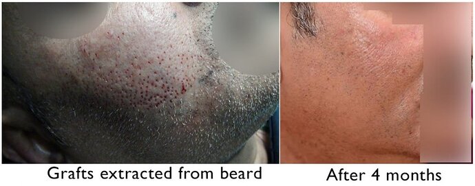 Check hair extraction (pics inside) & excellent healing photo