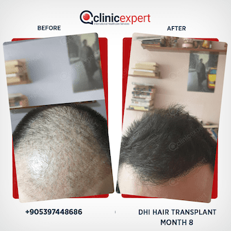 en-hair-transplant-ba12