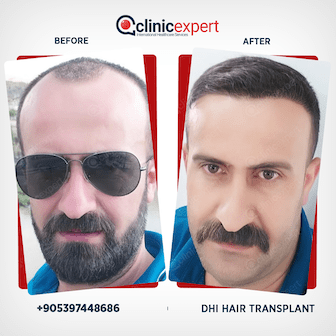 en-hair-transplant-ba3