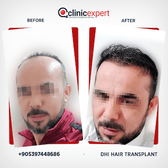 en-hair-transplant-ba1