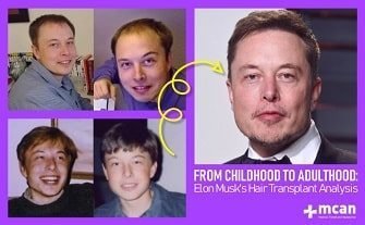 Everything About Elon Musk Hair Transplant - Forum Hair Transplant