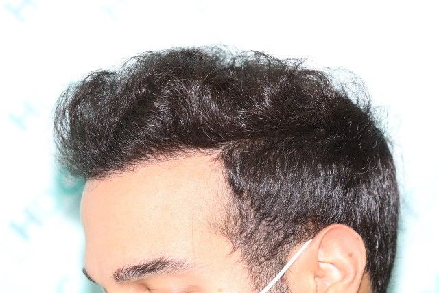 FUE Result for hairline and temples – 1 Year after 2980 grafts – HDC Hair Clinic photo