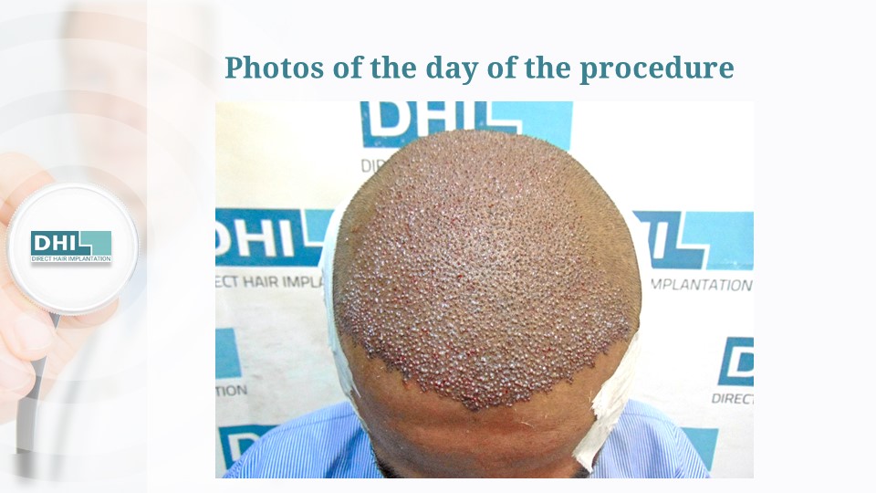 DHI India | NW Scale 6 | 4,127 Grafts | 9 Months DHI Hair Transplant Result photo